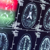Новое российское ПО для анализа нейронных связей поможет лечить деменцию